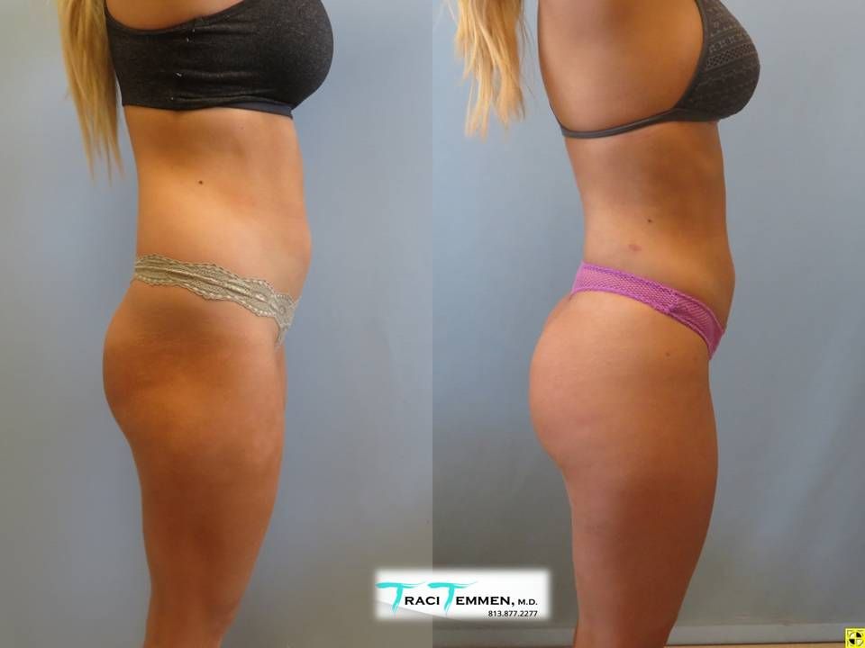 Brazilian Butt Lift Before & After