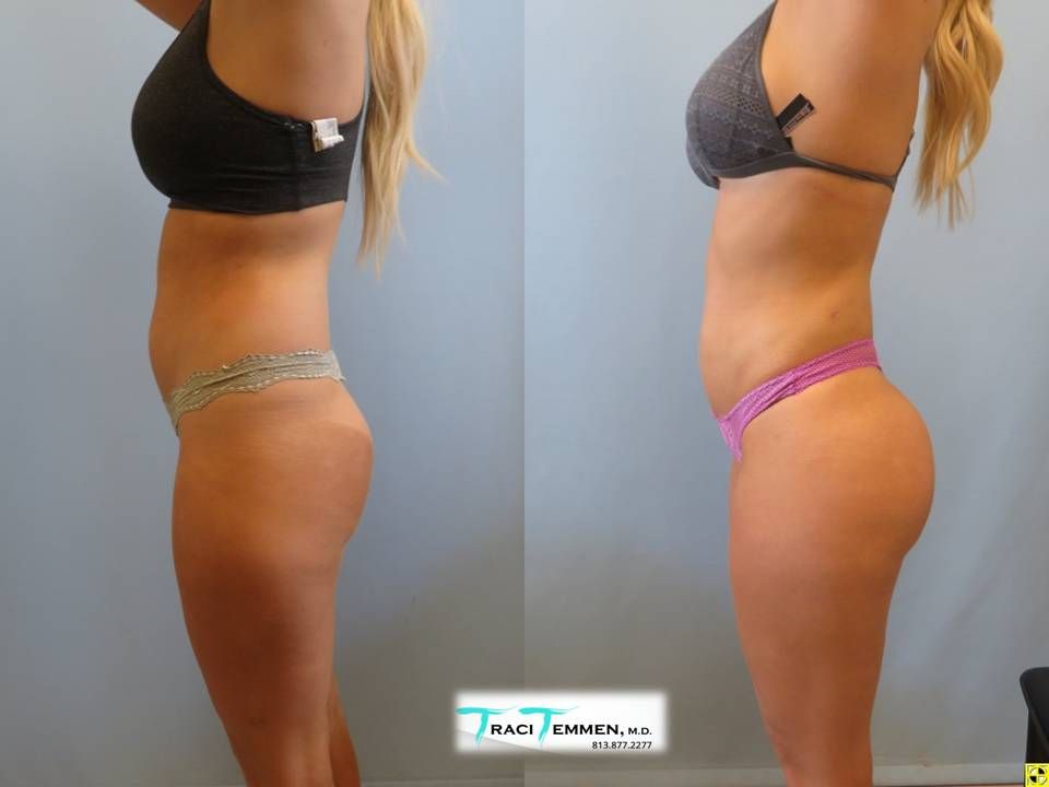 Brazilian Butt Lift Before & After