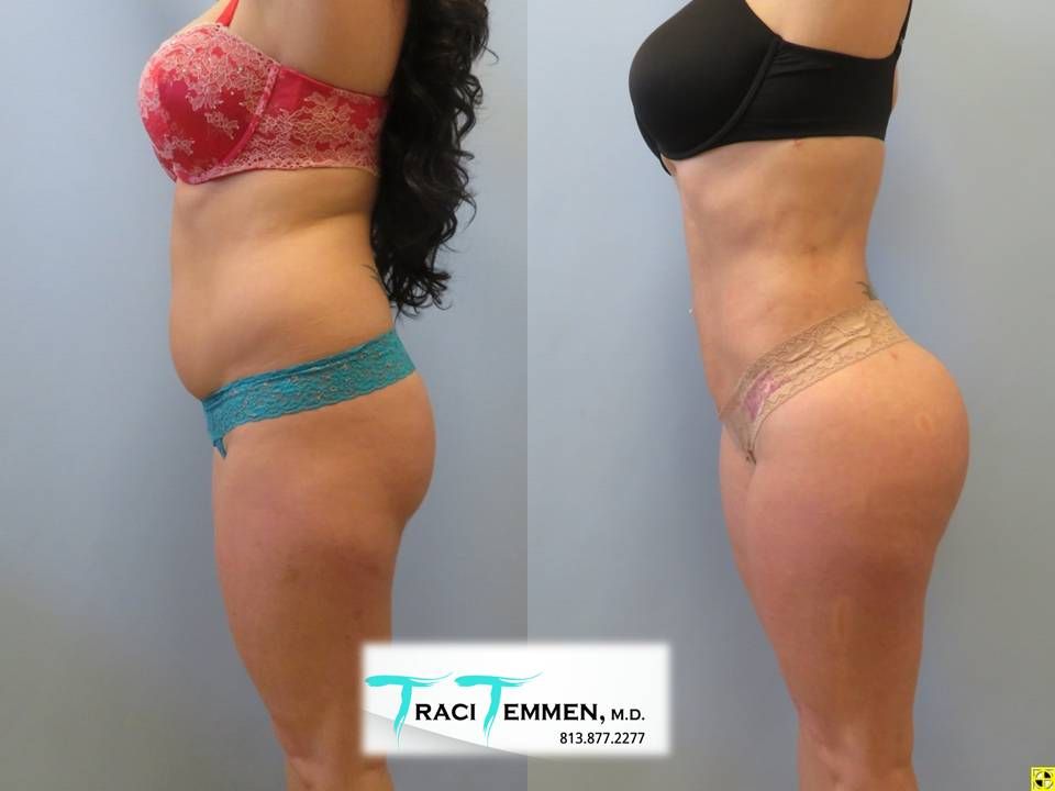 Brazilian Butt Lift Before & After