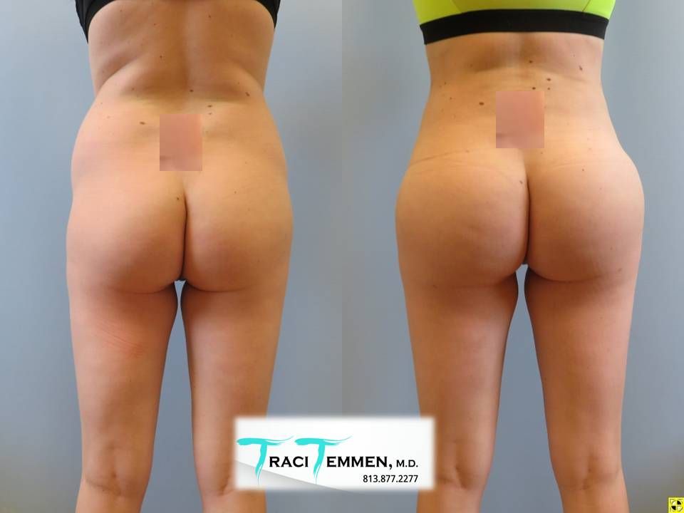 Brazilian Butt Lift Before & After