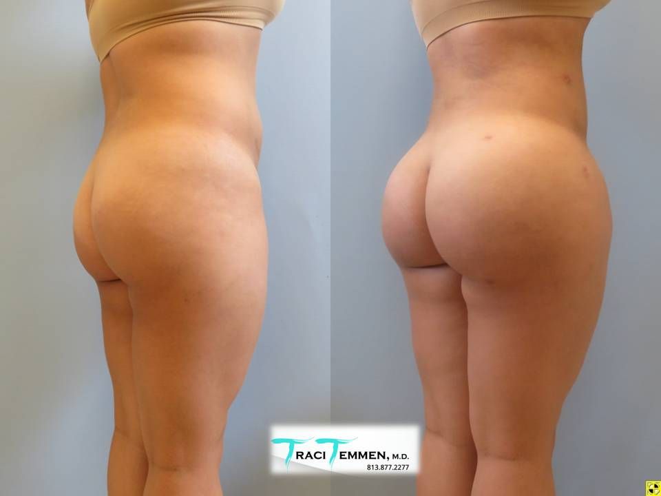 Brazilian Butt Lift Before & After