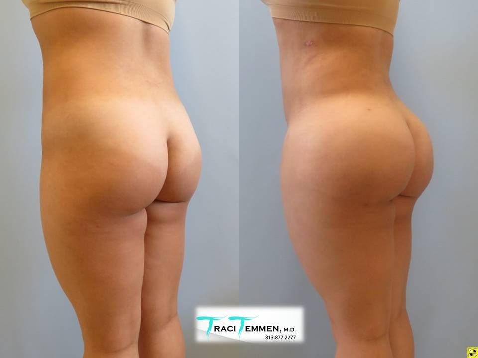 Brazilian Butt Lift Before & After