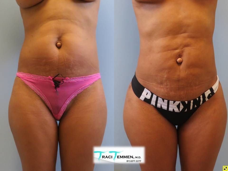 Brazilian Butt Lift Before & After