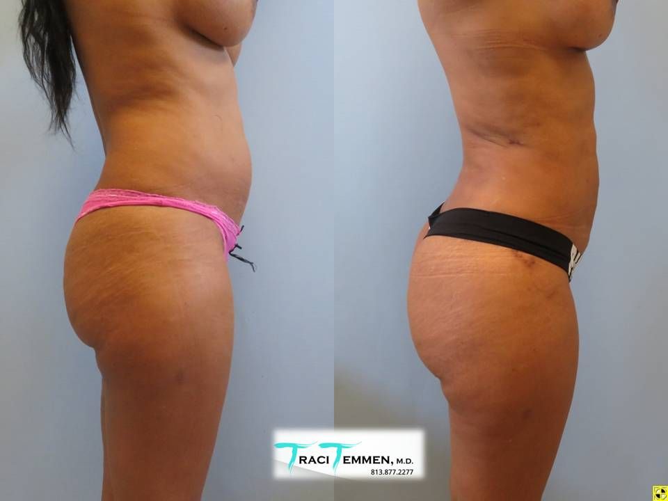 Brazilian Butt Lift Before & After