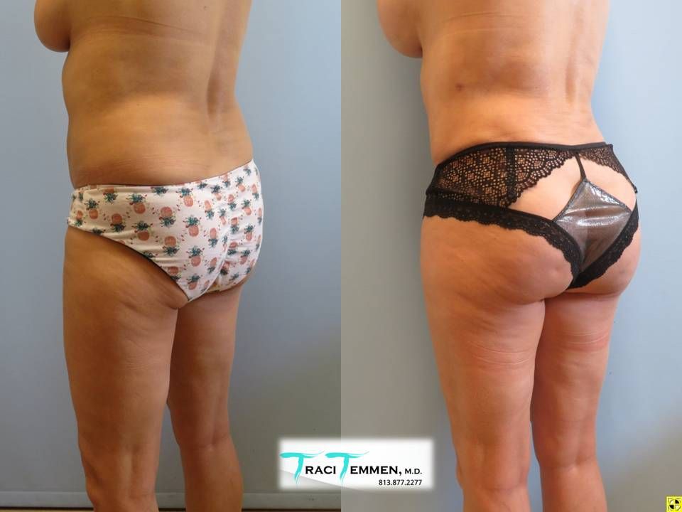 Brazilian Butt Lift Before & After