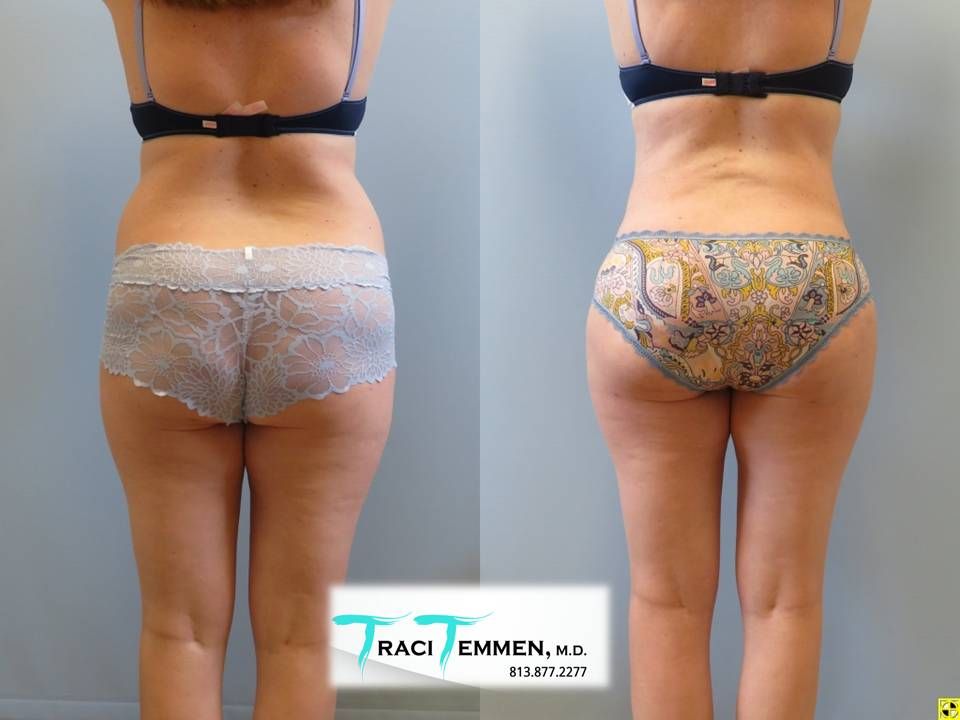 Brazilian Butt Lift Before & After