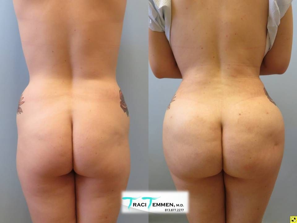 Brazilian Butt Lift Before & After