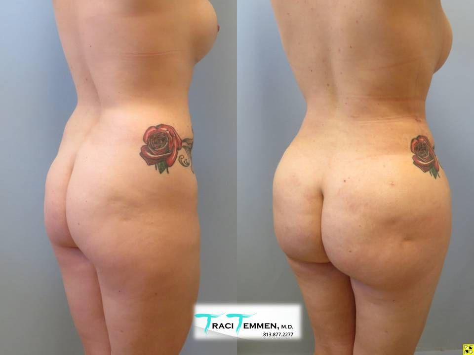 Brazilian Butt Lift Before & After