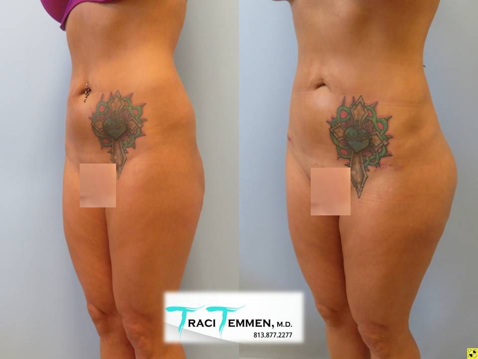 Brazilian Butt Lift Before & After