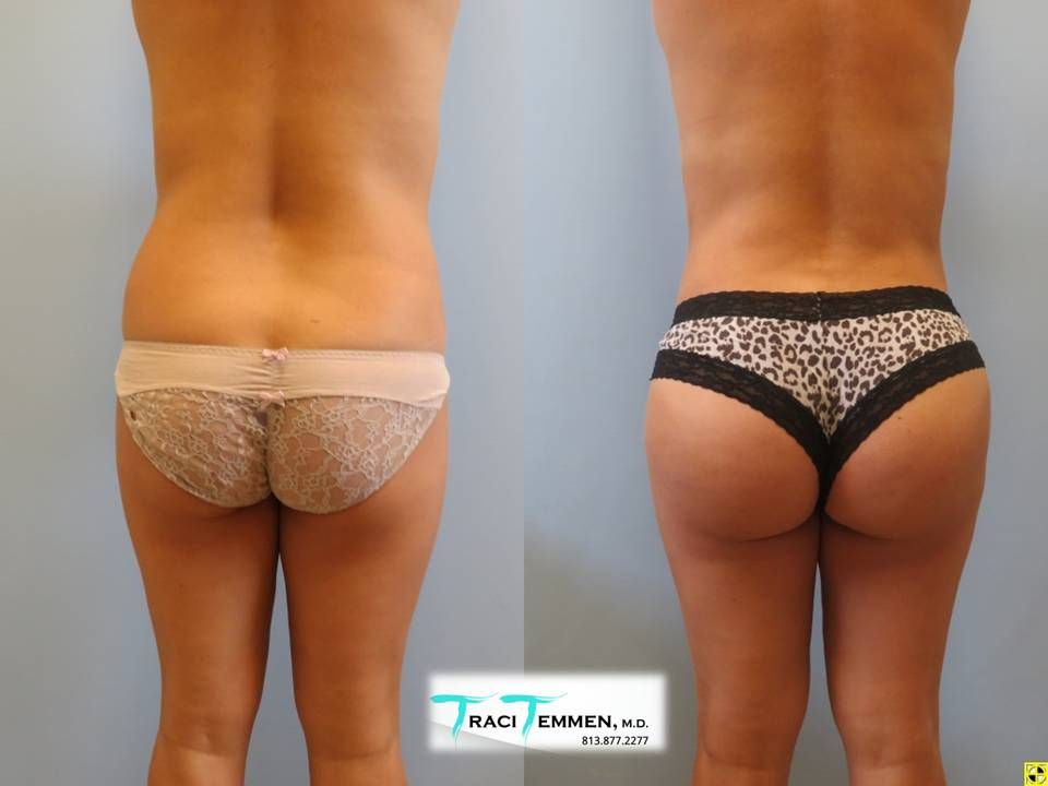 Brazilian Butt Lift Before & After