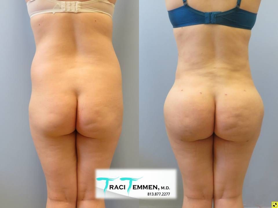 Brazilian Butt Lift Before & After