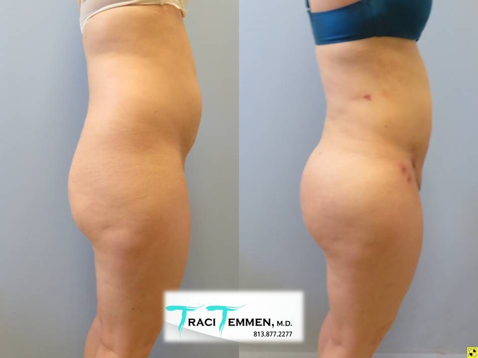 Brazilian Butt Lift Before & After