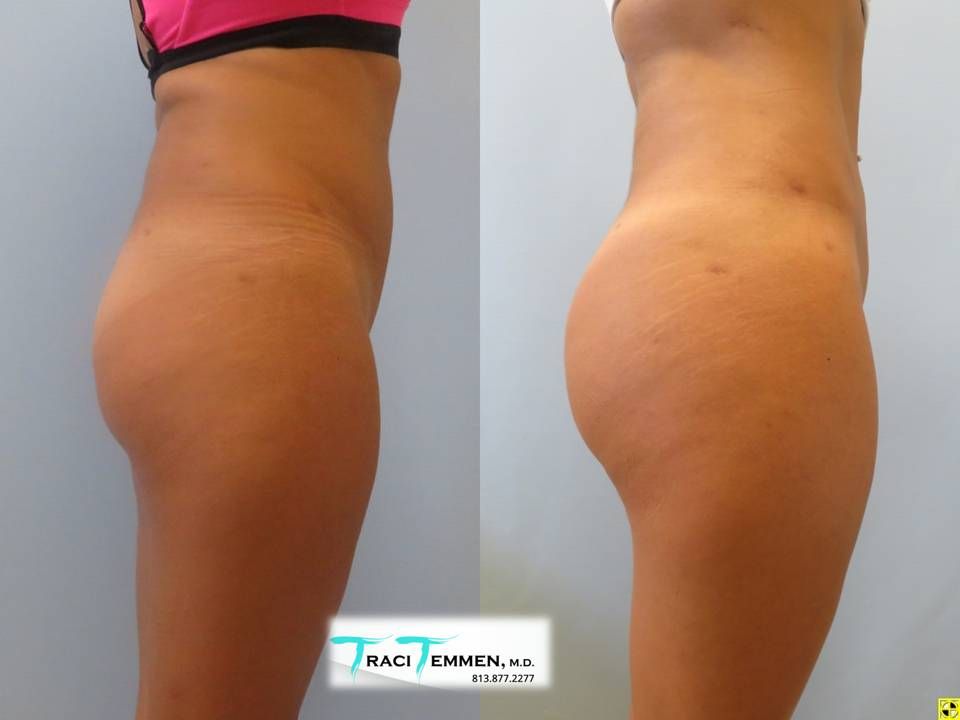 Brazilian Butt Lift Before & After