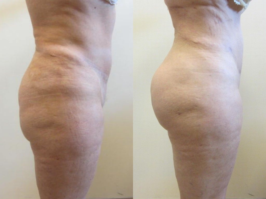 Brazilian Butt Lift Before & After