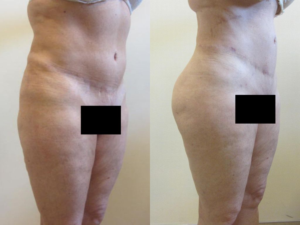 Brazilian Butt Lift Before & After