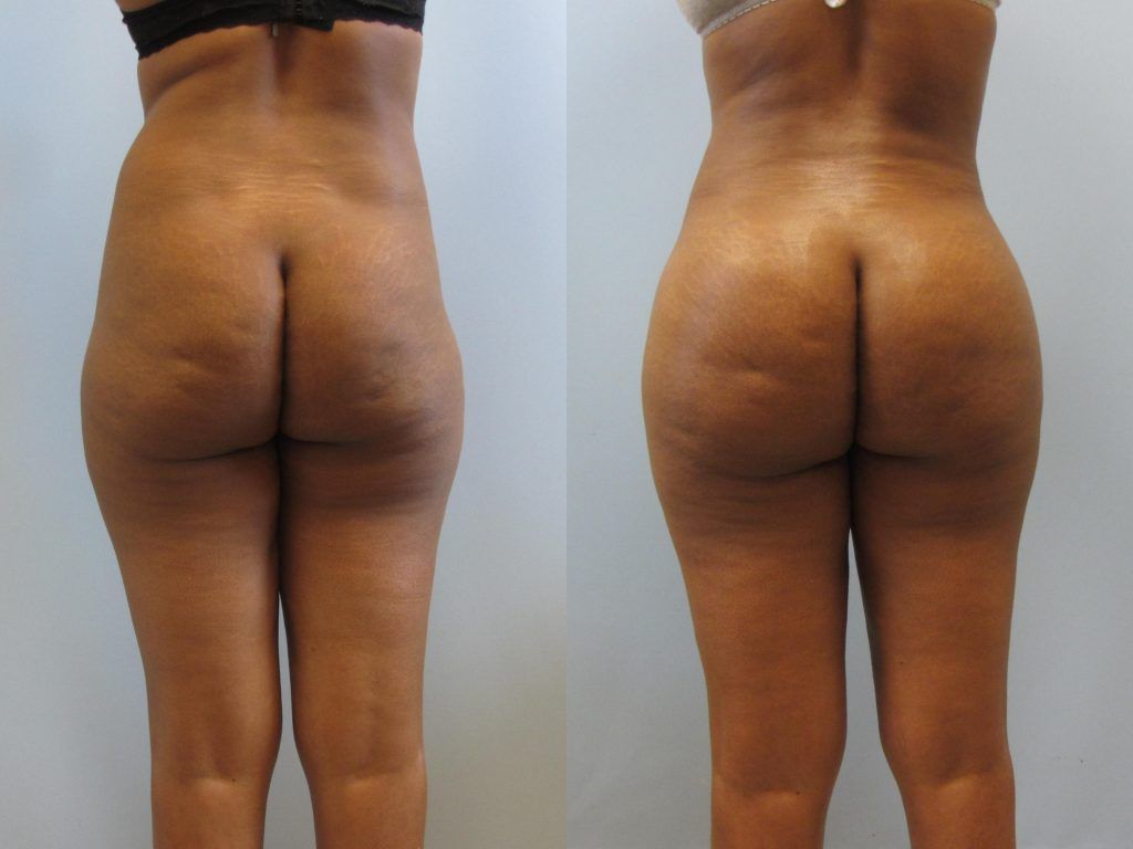 Brazilian Butt Lift Before & After