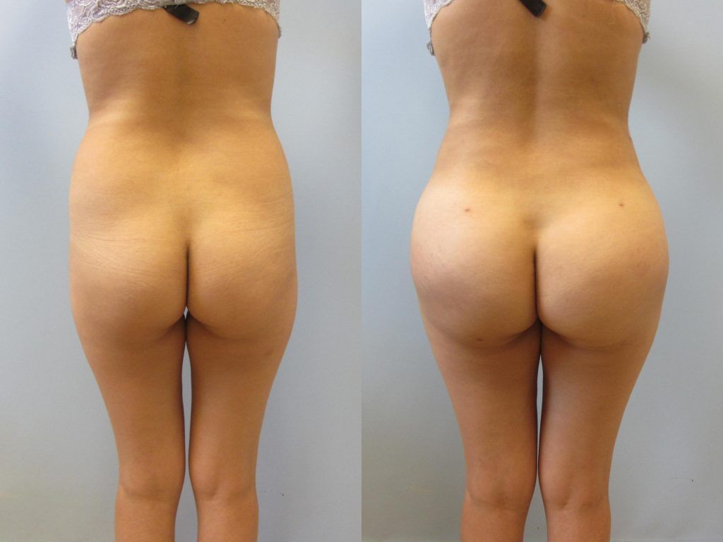 Brazilian Butt Lift Before & After