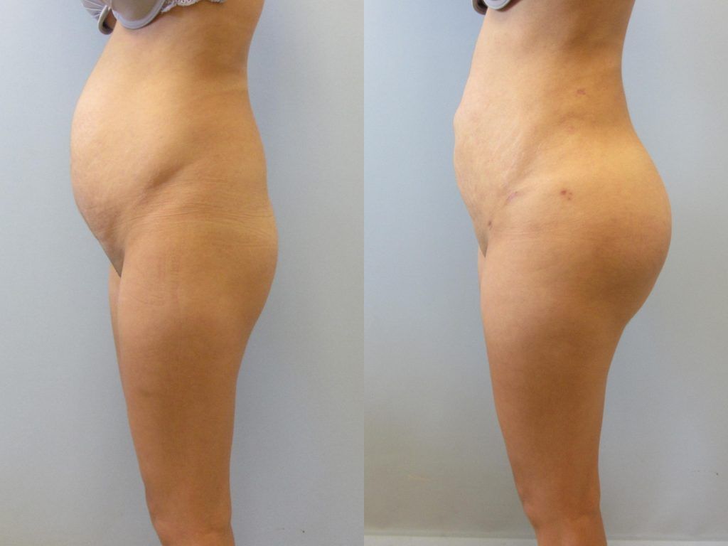 Brazilian Butt Lift Before & After