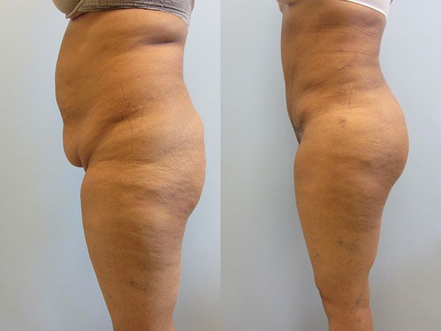 Brazilian Butt Lift Before & After