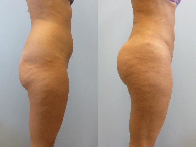 Brazilian Butt Lift Before & After