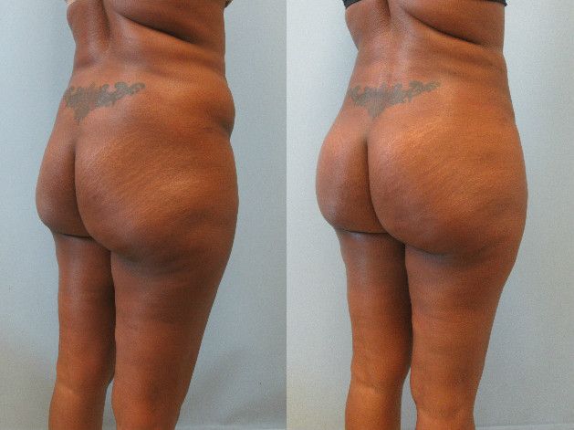 Brazilian Butt Lift Before & After