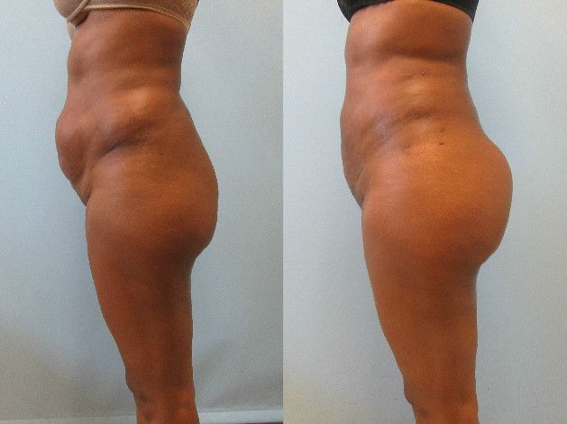 Brazilian Butt Lift Before & After