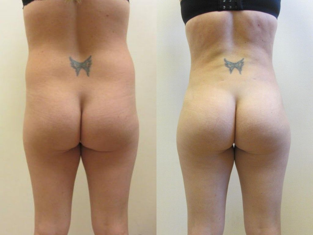 Brazilian Butt Lift Before & After