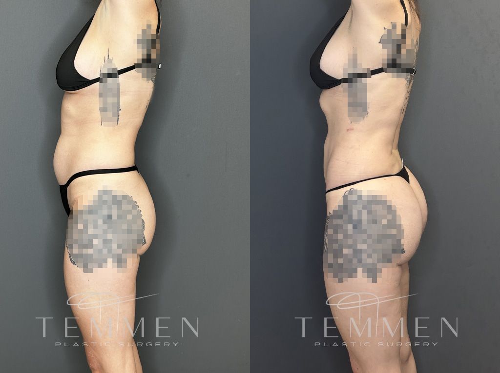 Brazilian Butt Lift Before & After