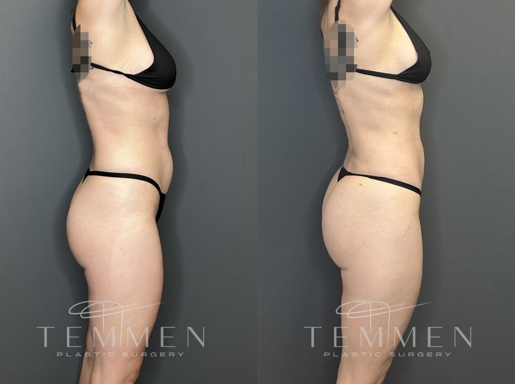 Brazilian Butt Lift Before & After
