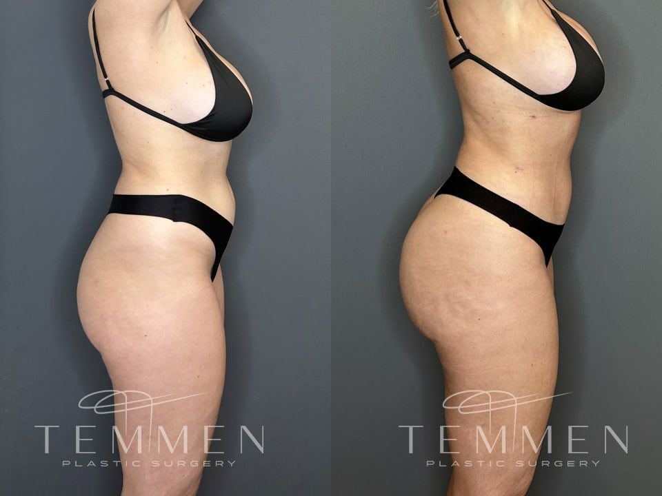 Brazilian Butt Lift Before & After