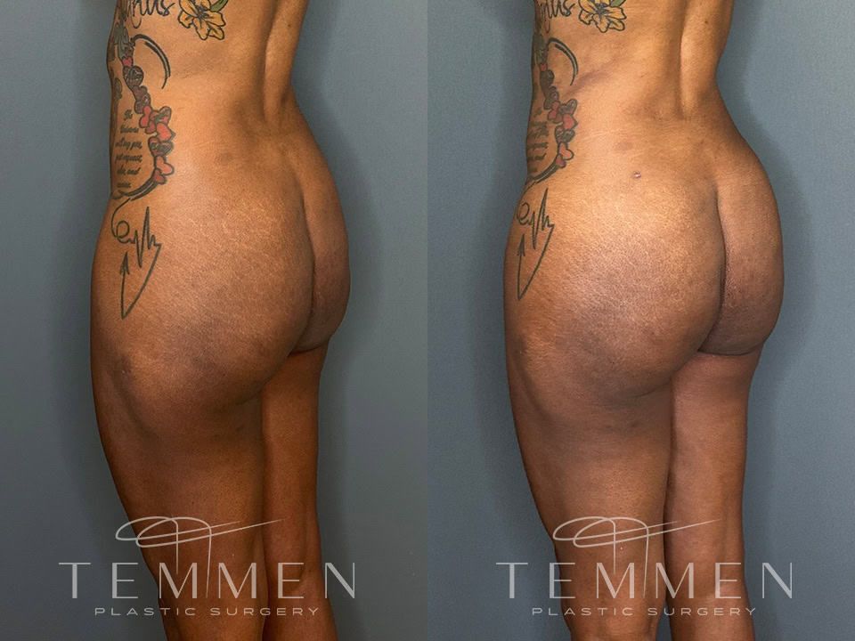 Brazilian Butt Lift Before & After