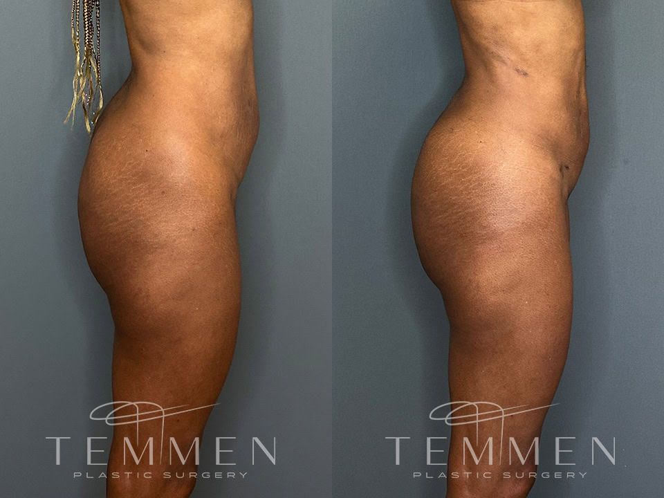 Brazilian Butt Lift Before & After