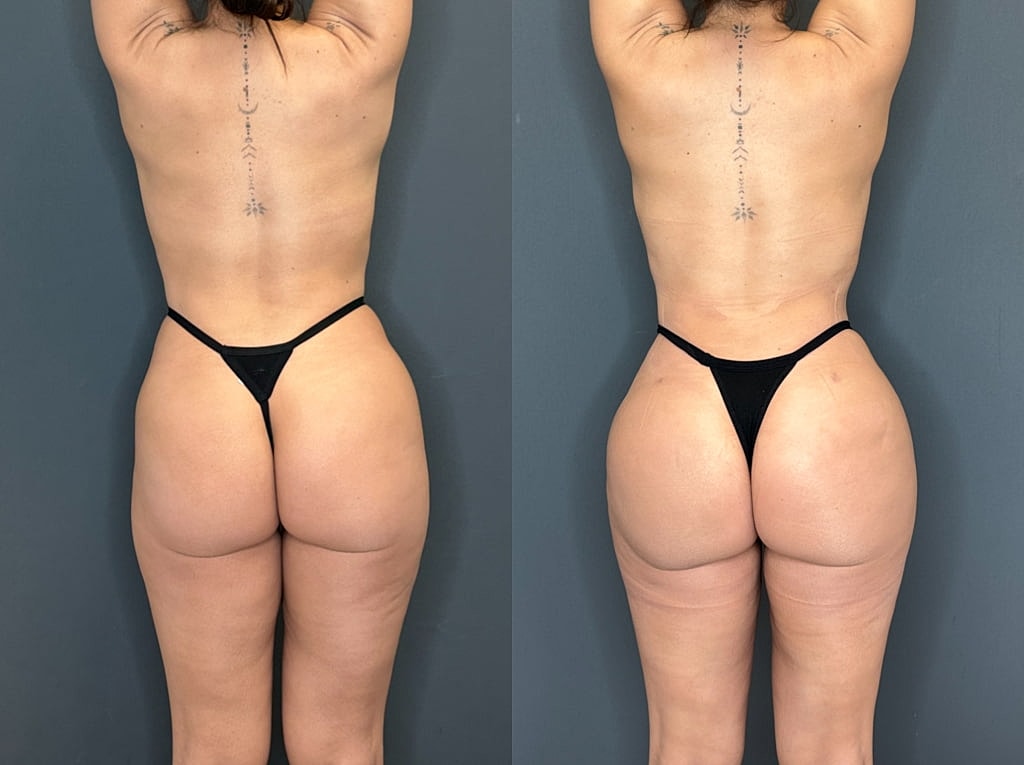 Brazilian Butt Lift Before & After