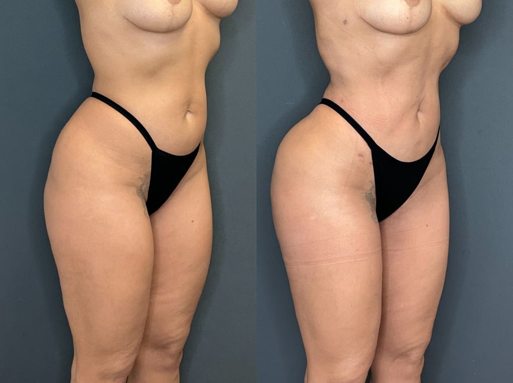 Brazilian Butt Lift Before & After