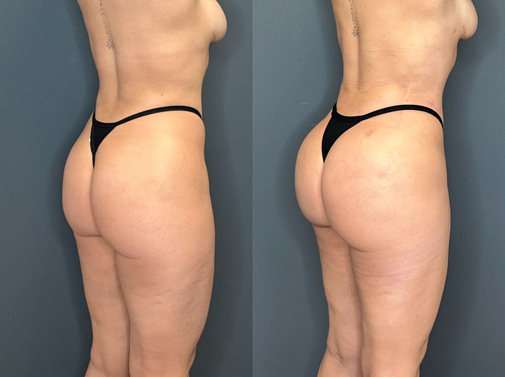 Brazilian Butt Lift Before & After