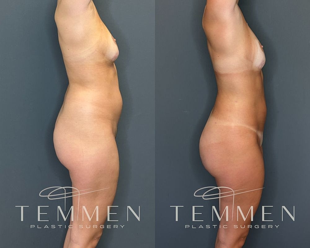 Before and after plastic surgery side view comparison.