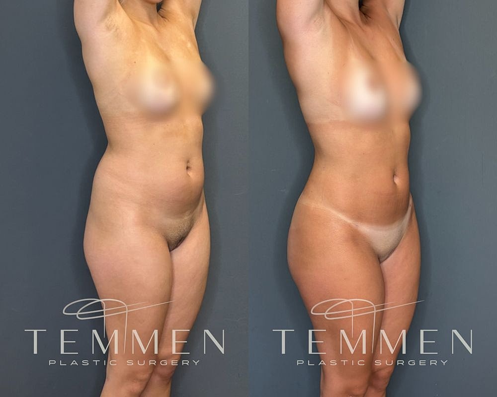 Before and after body contouring procedure comparison.