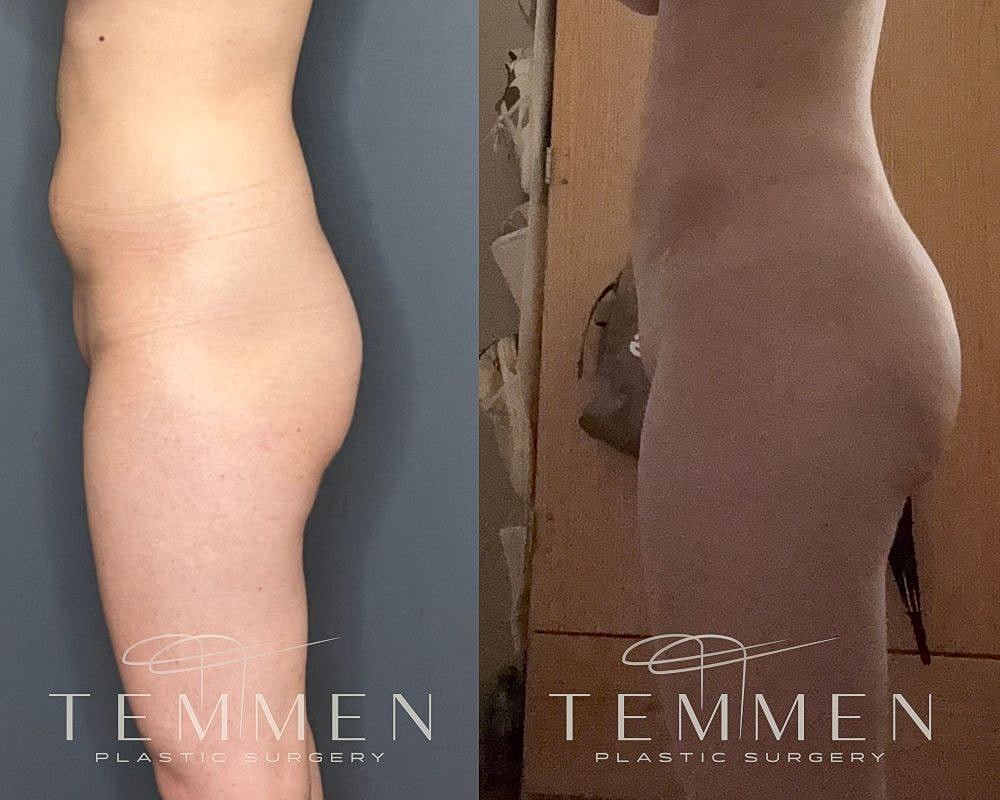 Brazilian Butt Lift Before & After