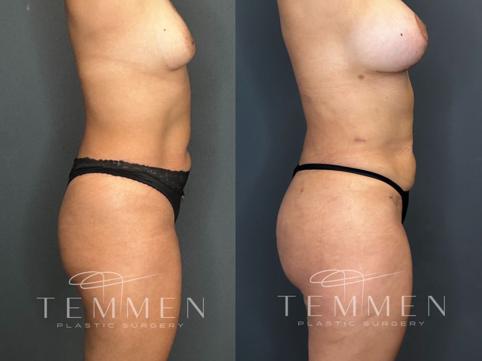 Brazilian Butt Lift Before & After