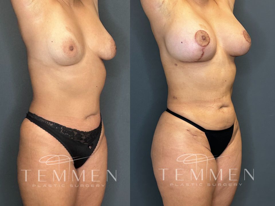 Brazilian Butt Lift Before & After