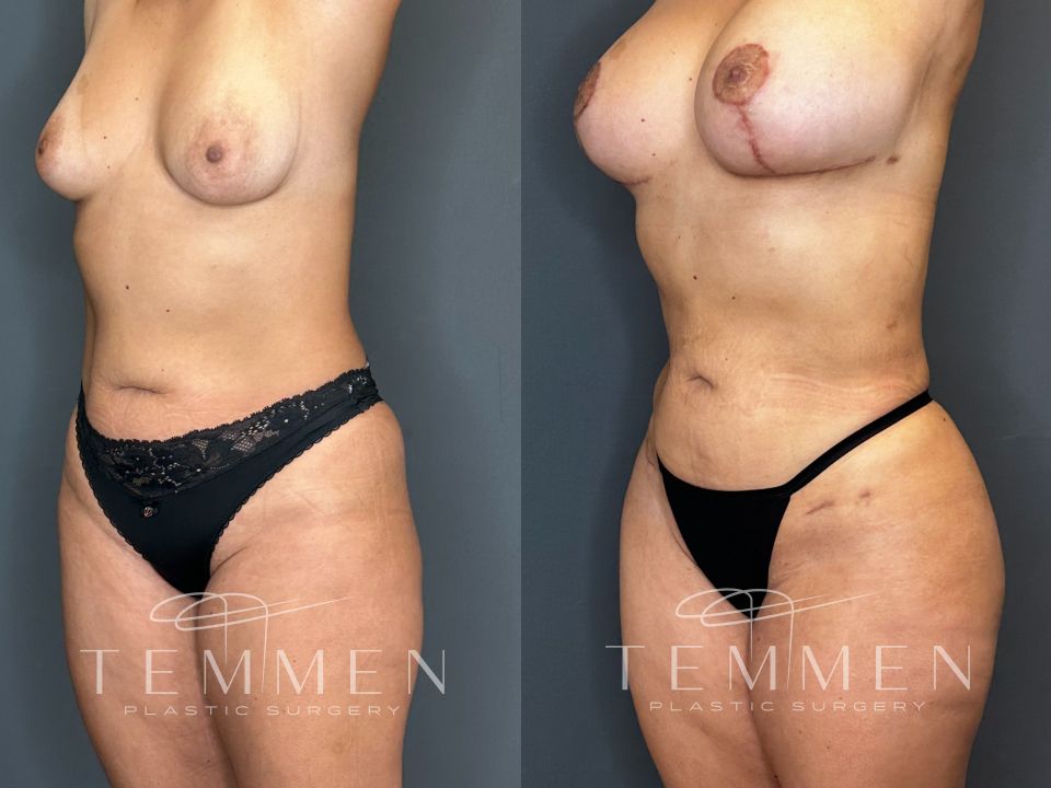 Brazilian Butt Lift Before & After