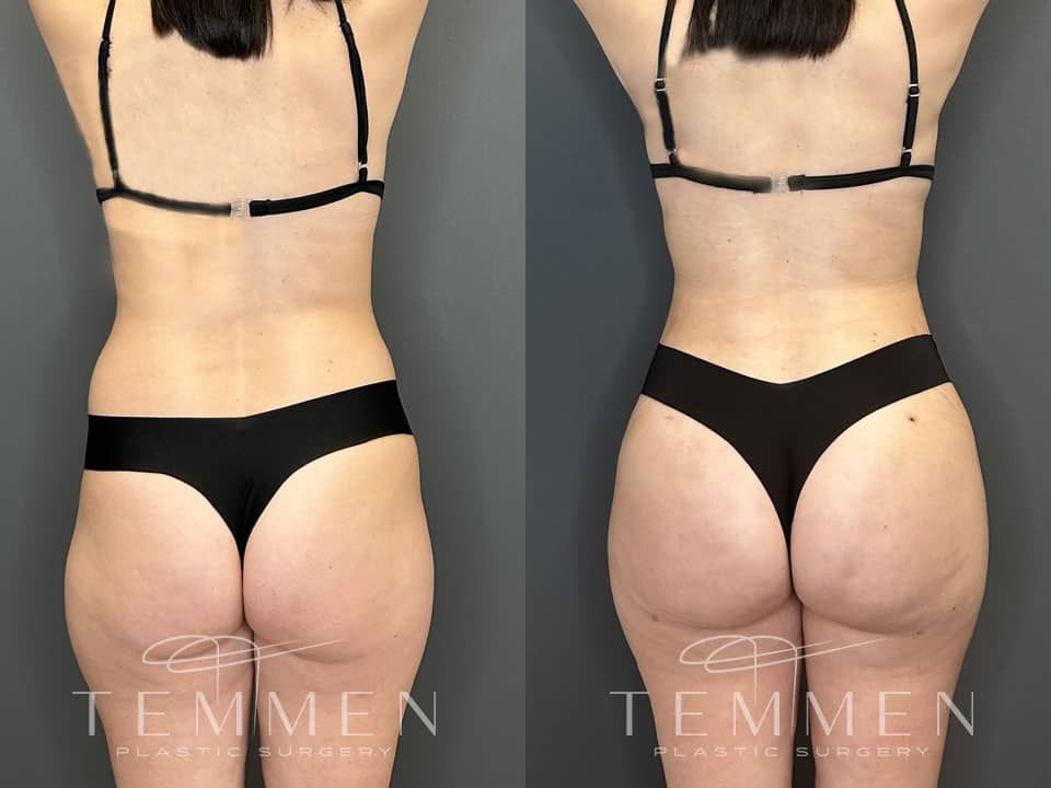 Brazilian Butt Lift Before & After