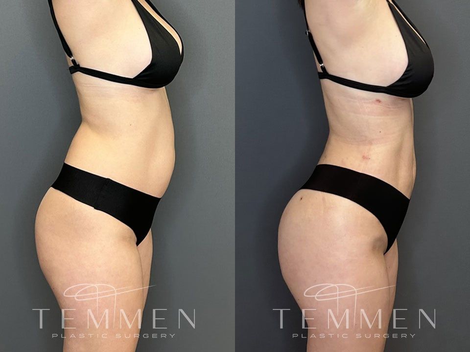 Brazilian Butt Lift Before & After