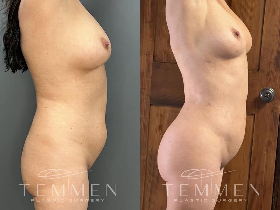 Brazilian Butt Lift Before & After