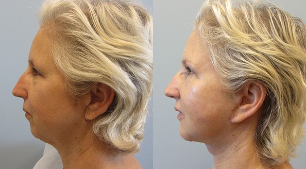 Face Lift Before & After