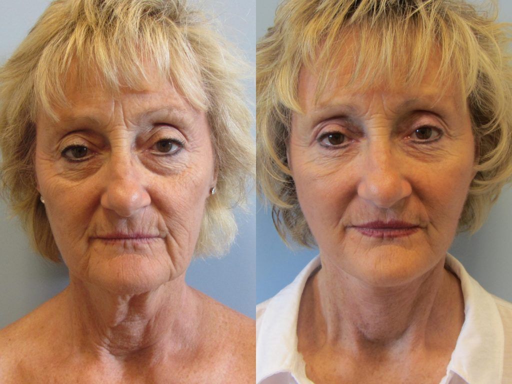Face Lift Before & After