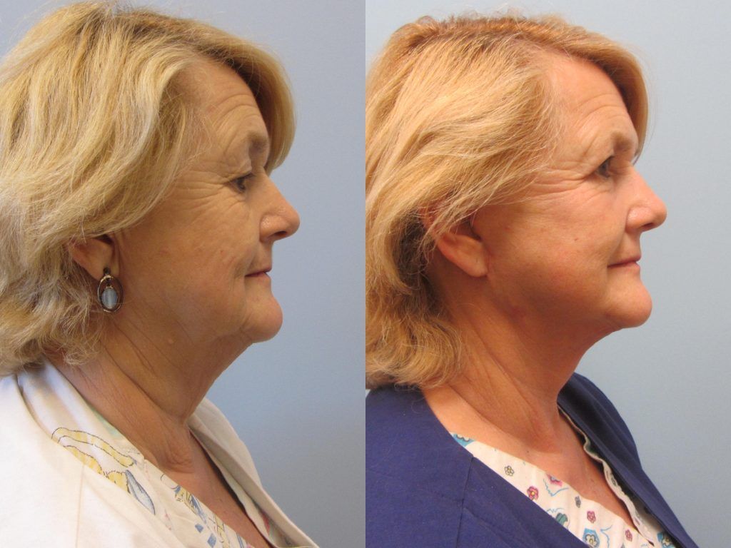 Face Lift Before & After