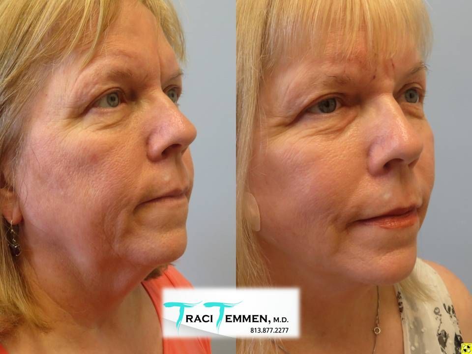 Face Lift Before & After