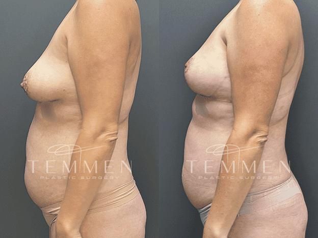 Breast Asymmetry Before & After