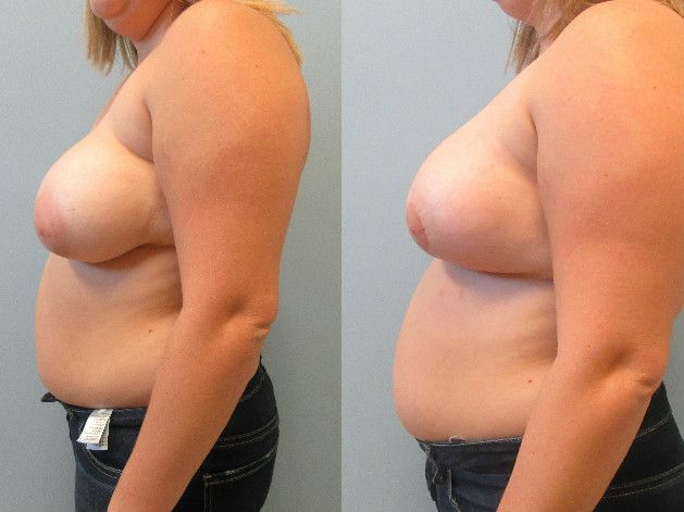 Breast Asymmetry Before & After